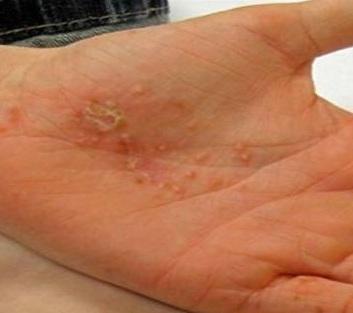 Tratamiento eficaz para la dishidrosis